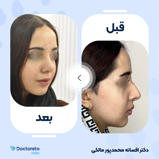 عمل زیبایی بینی (رینوپلاستی)