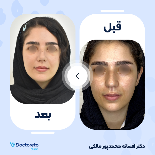 عمل زیبایی بینی (رینوپلاستی)