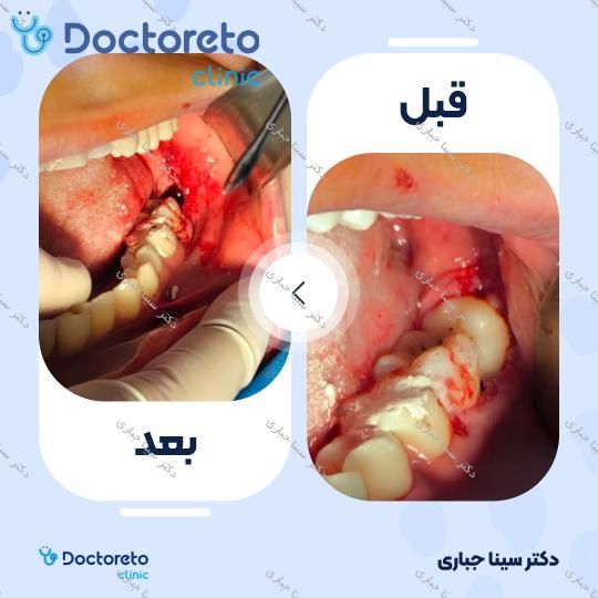 جراحی دندان عقل نهفته