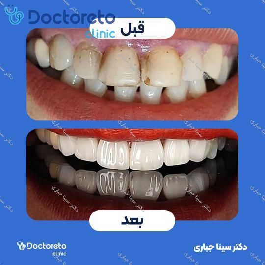ونیر کامپوزیت استاتیکس دنسپلی X-White (هر واحد)