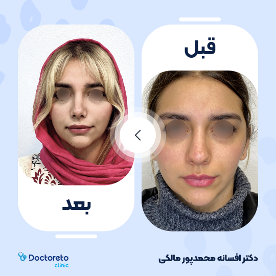 عمل جراحی مجدد زیبایی بینی (رینوپلاستی)