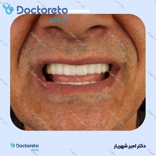 ایمپلنت spi سوئیسی با روکش (هر واحد)