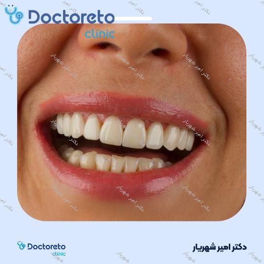 ایمپلنت دنتیوم کره ای با روکش (هر واحد)