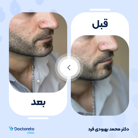 تزریق ژل چانه با برند نوکسیول (1cc)