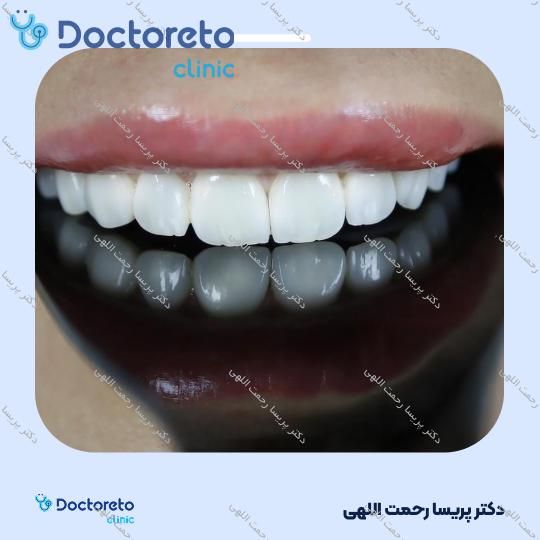 پکیج آفیس بلیچینگ (سفید کردن دندان ) دو فک و هوم بلیچینگ دو فک با مواد آلمانی whitesmile