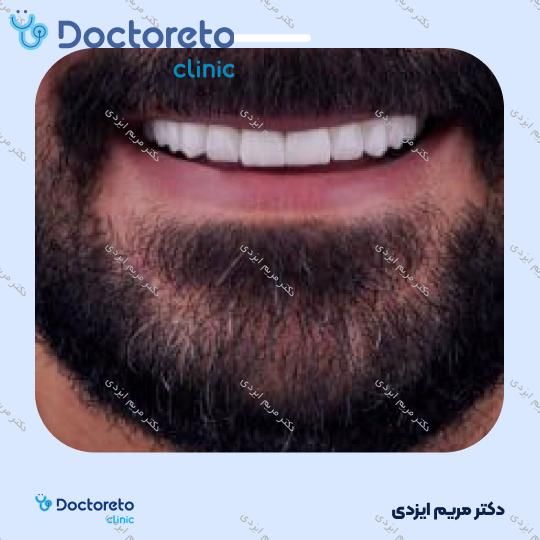 لمینت سرامیکی ایمکس آلمان (هر واحد)