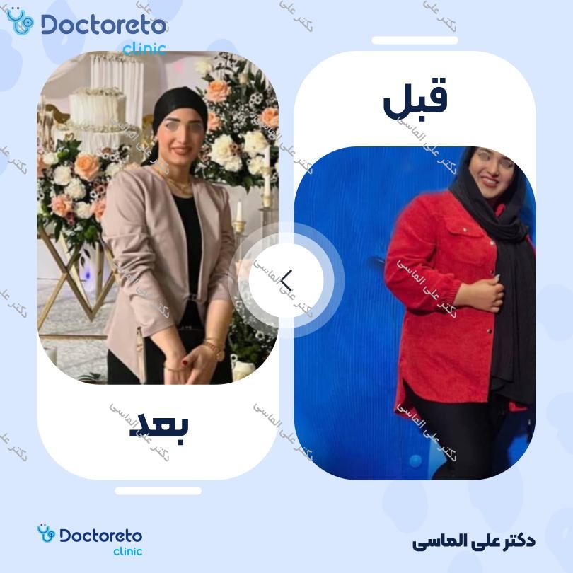 جراحی اسلیو معده