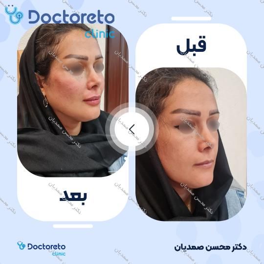 تزریق ژل چانه با برند اینووسنس (1cc)