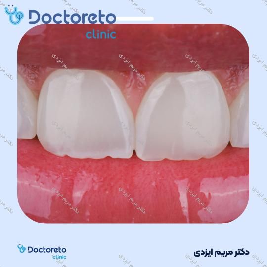 ونیر کامپوزیت توکویاما ژاپنی (هر واحد)