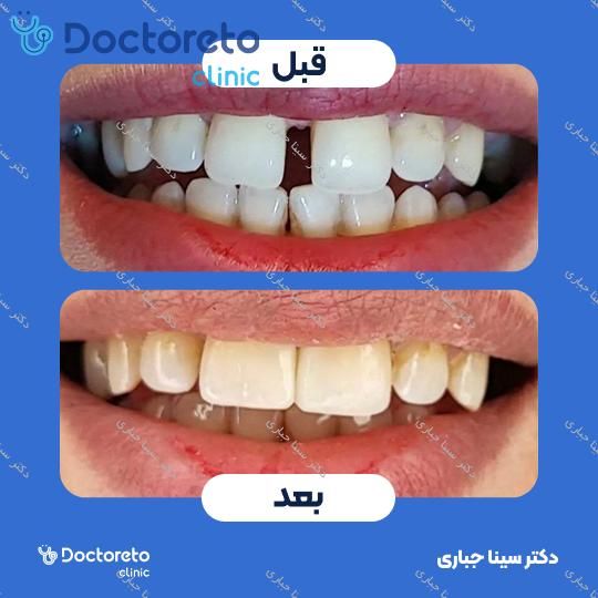 ونیر کامپوزیت استاتیکس دنسپلی X-White (هر واحد)