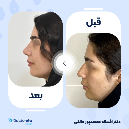 عمل جراحی مجدد زیبایی بینی (رینوپلاستی)