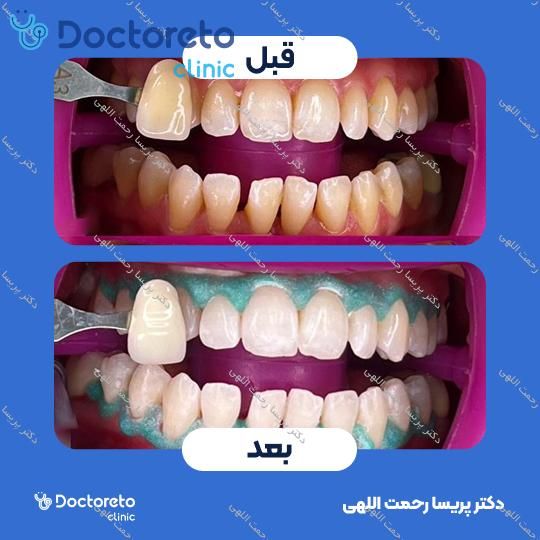 آفیس بلیچینگ (سفید کردن دندان) دو فک با مواد آمریکایی Boost