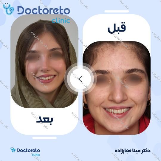 عمل زیبایی بینی (رینوپلاستی)