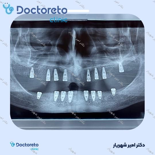 ایمپلنت نئودنت برزیلی با روکش (هر واحد)