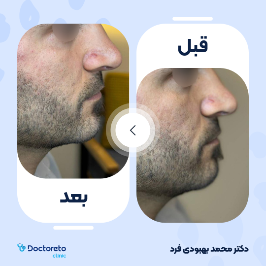 تزریق ژل چانه با برند پرفکتا (1CC)