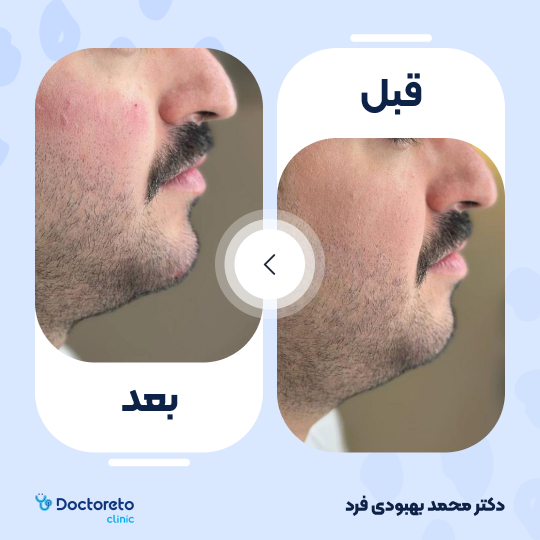تزریق ژل چانه با برند نوکسیول (1cc)