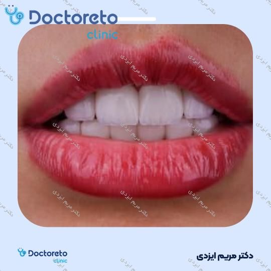 لمینت سرامیکی ایمکس آلمان (هر واحد)