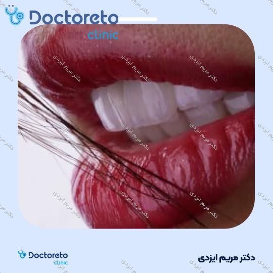 لمینت سرامیکی ایمکس آلمان (هر واحد)