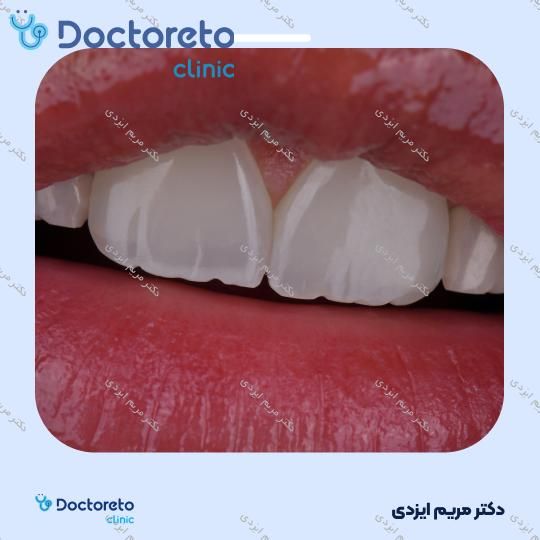 ونیر کامپوزیت توکویاما ژاپنی (هر واحد)