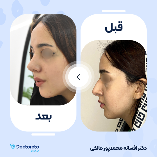 عمل زیبایی بینی (رینوپلاستی)