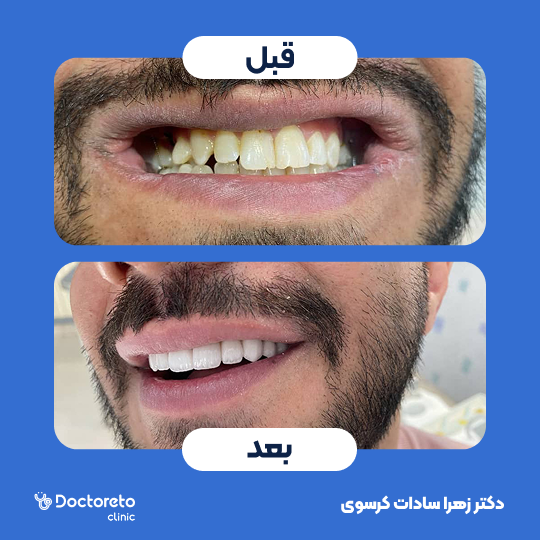 لمینت ایمکس vip (هر واحد)