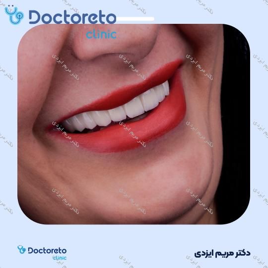 لمینت سرامیکی ایمکس آلمان (هر واحد)