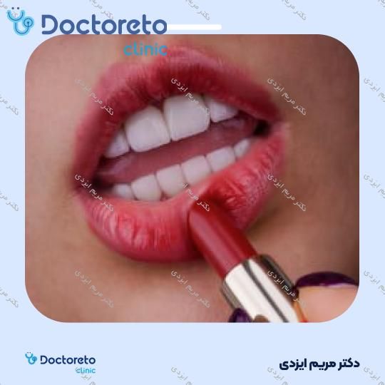 لمینت سرامیکی ایمکس آلمان (هر واحد)