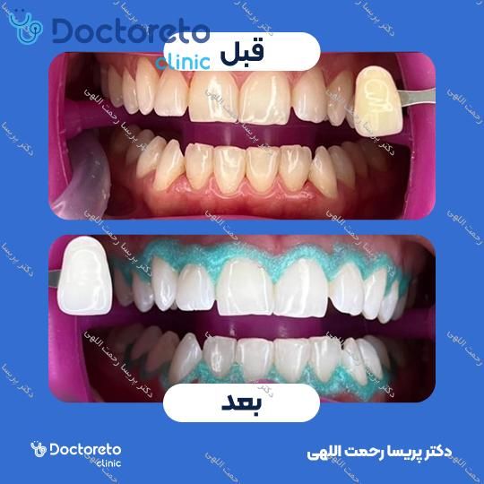 پکیج آفیس بلیچینگ (سفید کردن دندان ) دو فک و هوم بلیچینگ دو فک با مواد آلمانی whitesmile