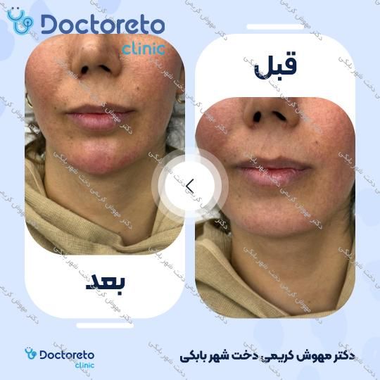 تزریق ژل چانه با برند EPTQ (هر سی سی)