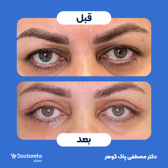 بلفاروپلاستی پلک بالا به روش جراحی