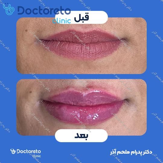 تزریق ژل لب با برند فیورج (1cc)