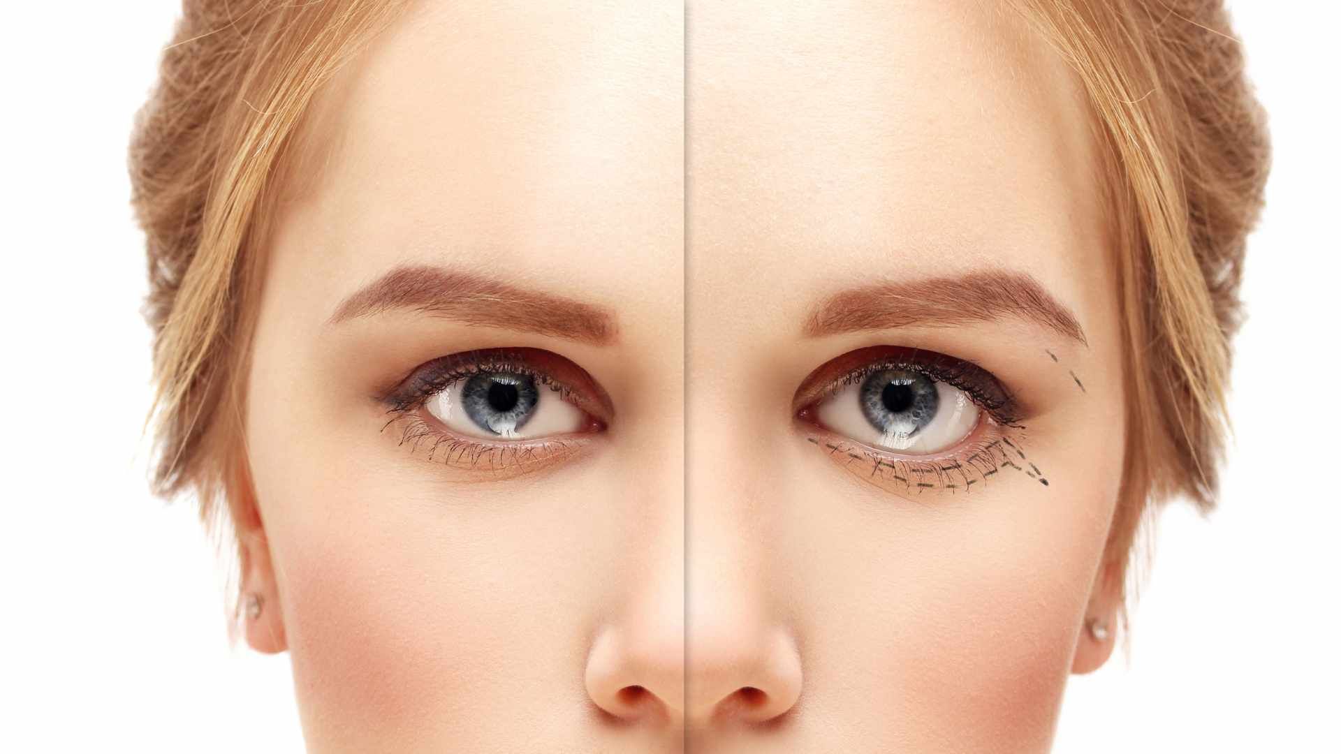 بلفاروپلاستی پلک پایین به روش جراحی