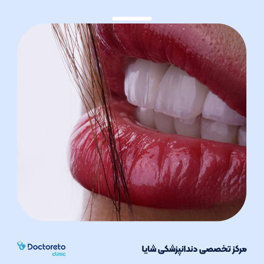 لمینت آی پی اس ایمکس تمام دیجیتال (هر واحد)