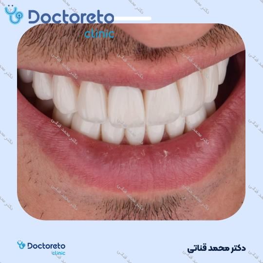 لمینت سرامیکی ایمکس آلمان (هر واحد)