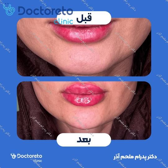 تزریق ژل چانه با برند فیورج (1cc)