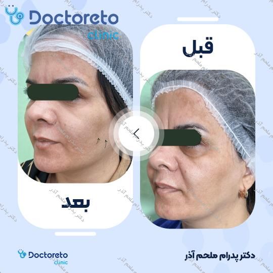 بازسازی صورت به روش تزریق چربی در (کل صورت)