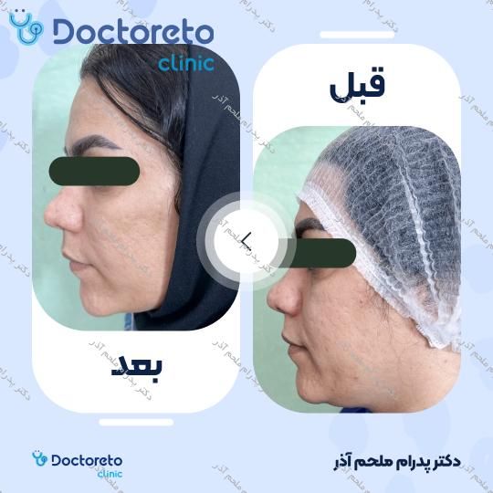 بازسازی صورت به روش تزریق چربی در (کل صورت)
