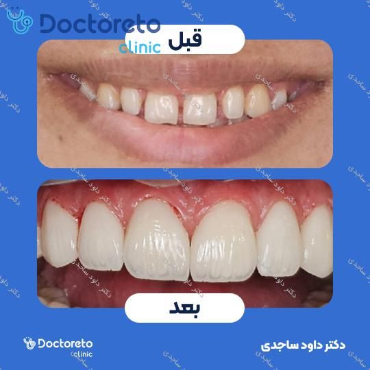 هوم بلیچینگ (سفید کردن دندان) دو فک برزیلی