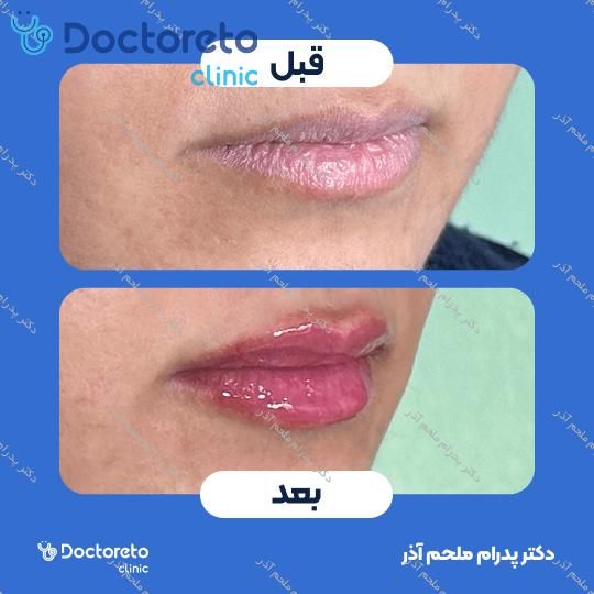 تزریق ژل لب با برند فیورج (1cc)