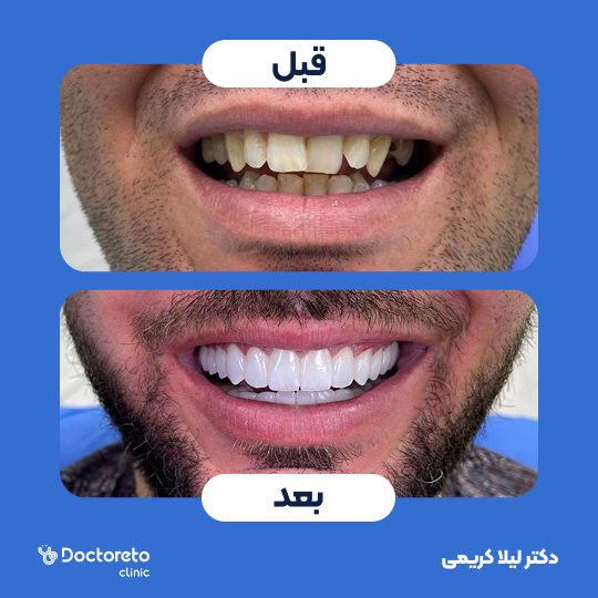 لمینت سرامیکی ایمکس (هر واحد)