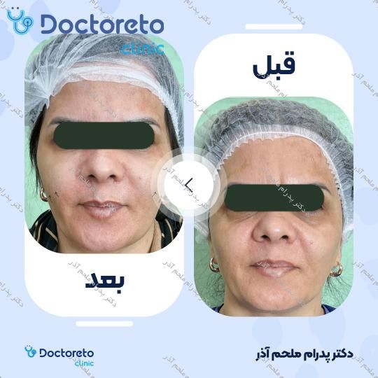 بازسازی صورت به روش تزریق چربی در (کل صورت)