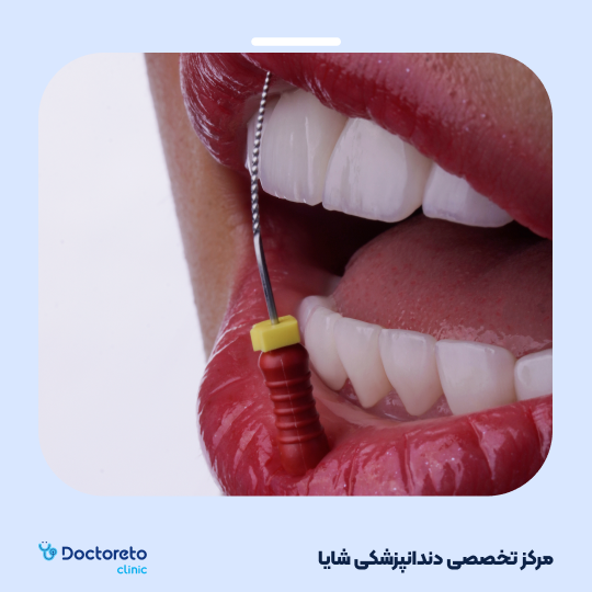 لمینت آی پی اس ایمکس تمام دیجیتال (هر واحد)