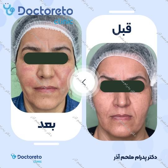 بازسازی صورت به روش تزریق چربی در (کل صورت)
