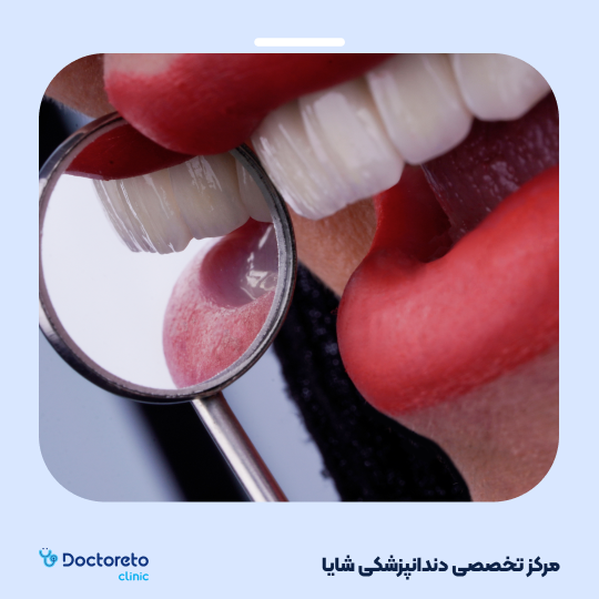 لمینت آی پی اس ایمکس تمام دیجیتال (هر واحد)