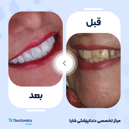 لمینت آی پی اس ایمکس تمام دیجیتال (هر واحد)