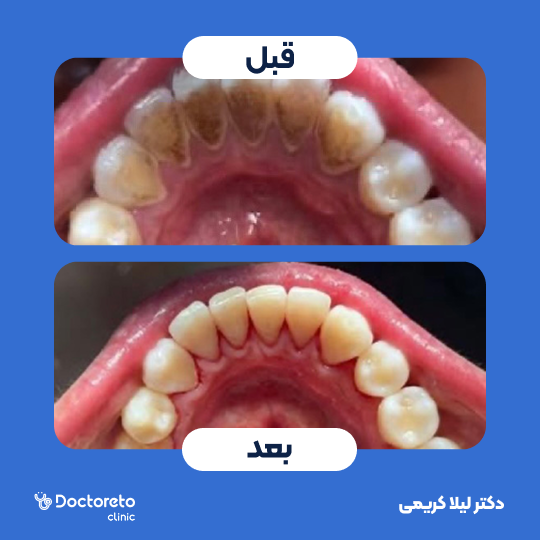 جرمگیری هر فک با بروساژ