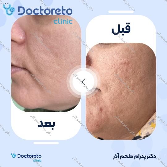 جوانسازی ورفع جای زخم و اسکار آکنه کل صورت با لیزر CO2 (هرجلسه)