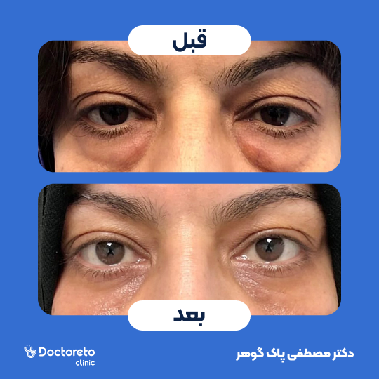 بلفاروپلاستی پلک بالا به روش لیزر