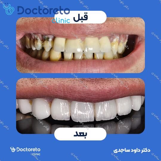 آفیس بلیچینگ (سفید کردن دندان) دو فک با برند white sense