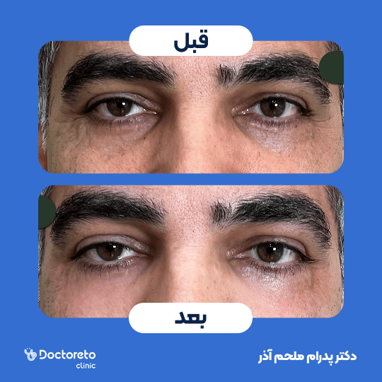 تزریق ژل زیرچشم با برند اینووسنس (1cc)